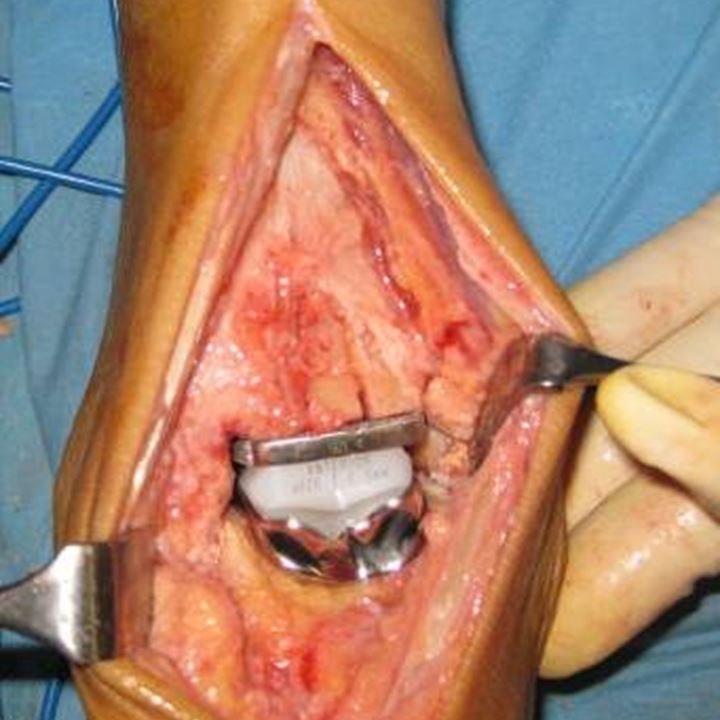 Operationsbild einer implantierten Sprunggelenkstotalprothese Typ Mobility